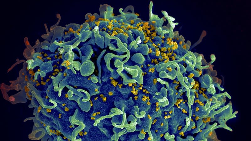 This electron microscope image made available by the U.S. National Institutes of Health shows a human T cell, in blue, under attack by HIV, in yellow, the virus that causes AIDS.