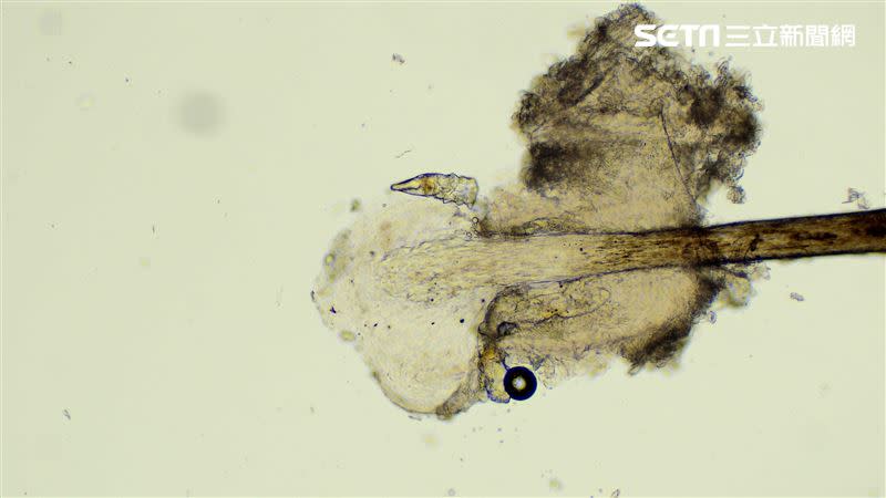皮脂蠕形蟎（圖／亞大醫院提供）