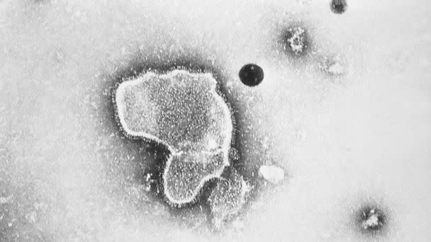 PHOTO: This 1981 photo provided by the Centers for Disease Control and Prevention (CDC) shows an electron micrograph of Respiratory Syncytial Virus, also known as RSV. (CDC via AP, FILE)