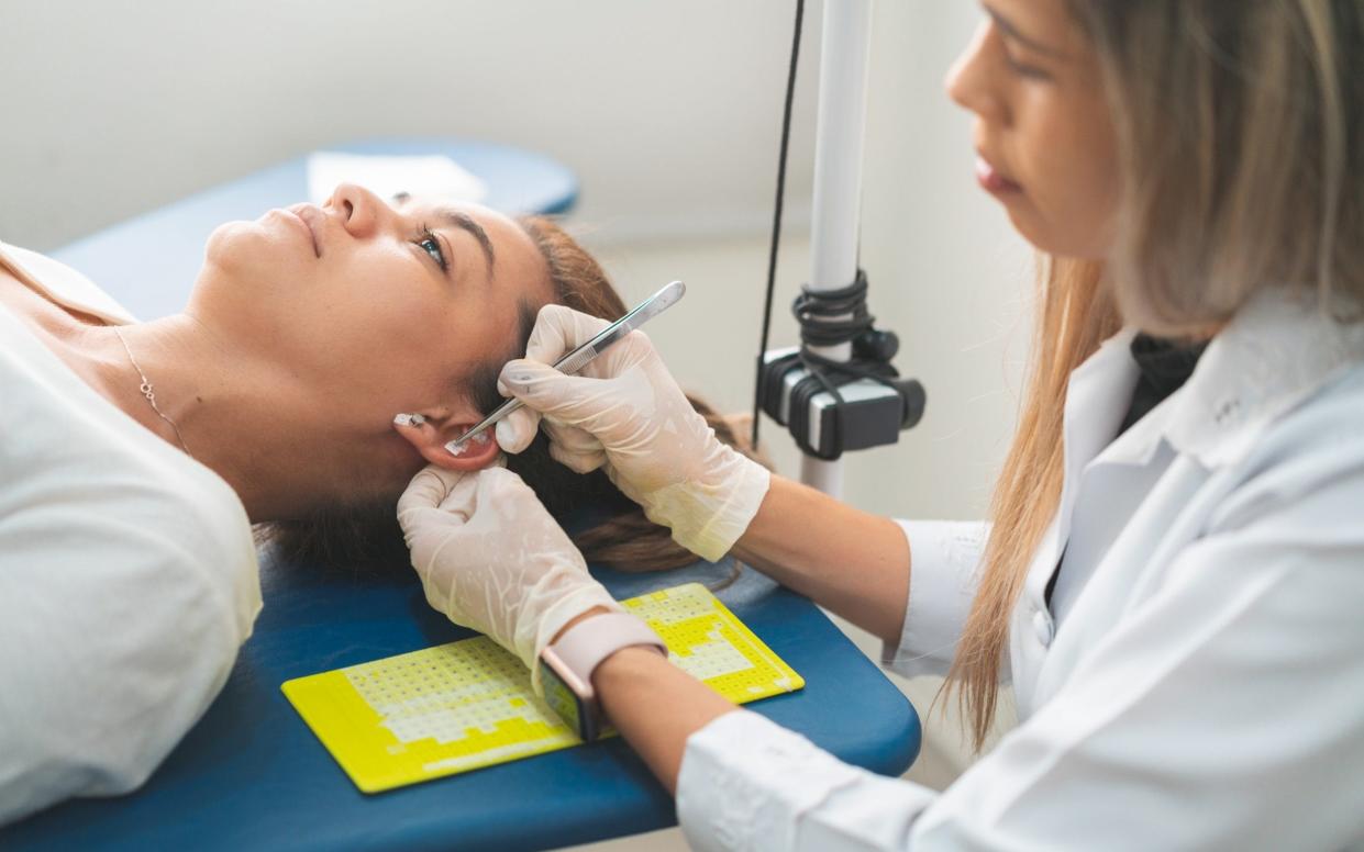 Ear acupuncture