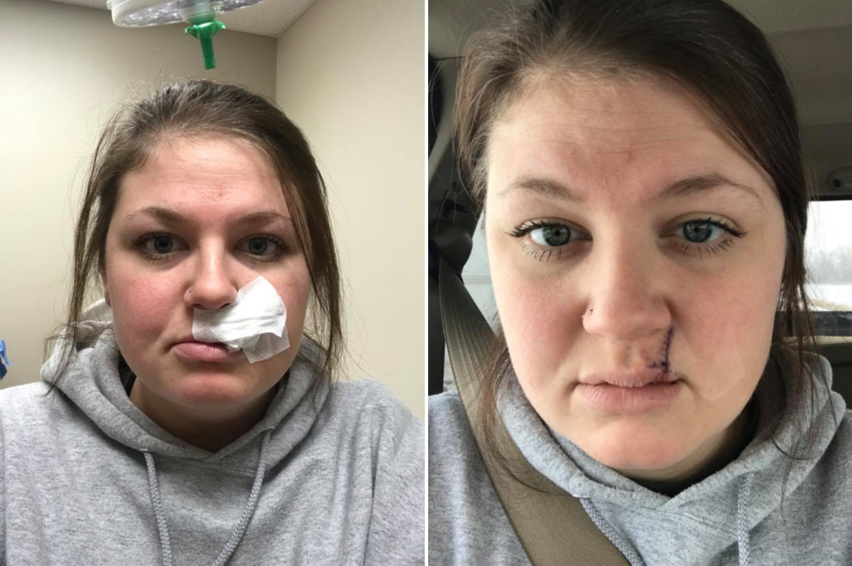 Mallory Lubbock, 26, shares selfies post-skin cancer removal on Facebook. (Photo: Facebook/Mallory Lubbock)