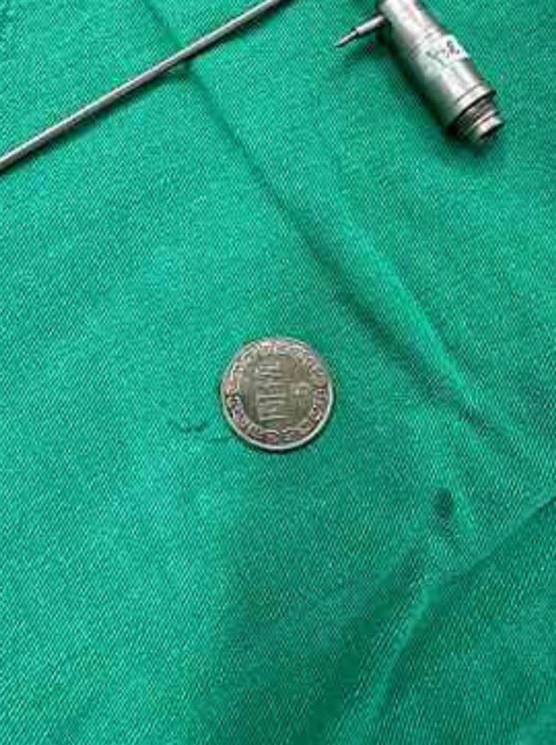羅文裕兒子仔仔最後手術拿出一個五元硬幣。（圖／翻攝羅文裕臉書）