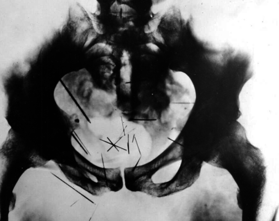 X-ray of Albert Fish's pelvis