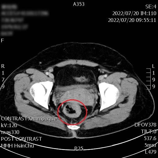 斷層掃描影像顯示，病患病人在上段直腸有一個約5公分的惡性腫瘤。（記者曾芳蘭翻攝）
