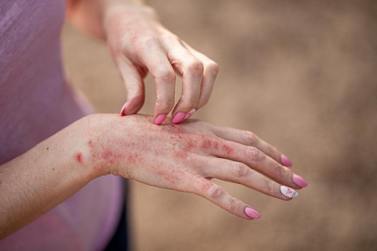 What is contact dermatitis? The NHS explains symptoms and when to see a doctor or pharmacist <i>(Image: Getty Images)</i>