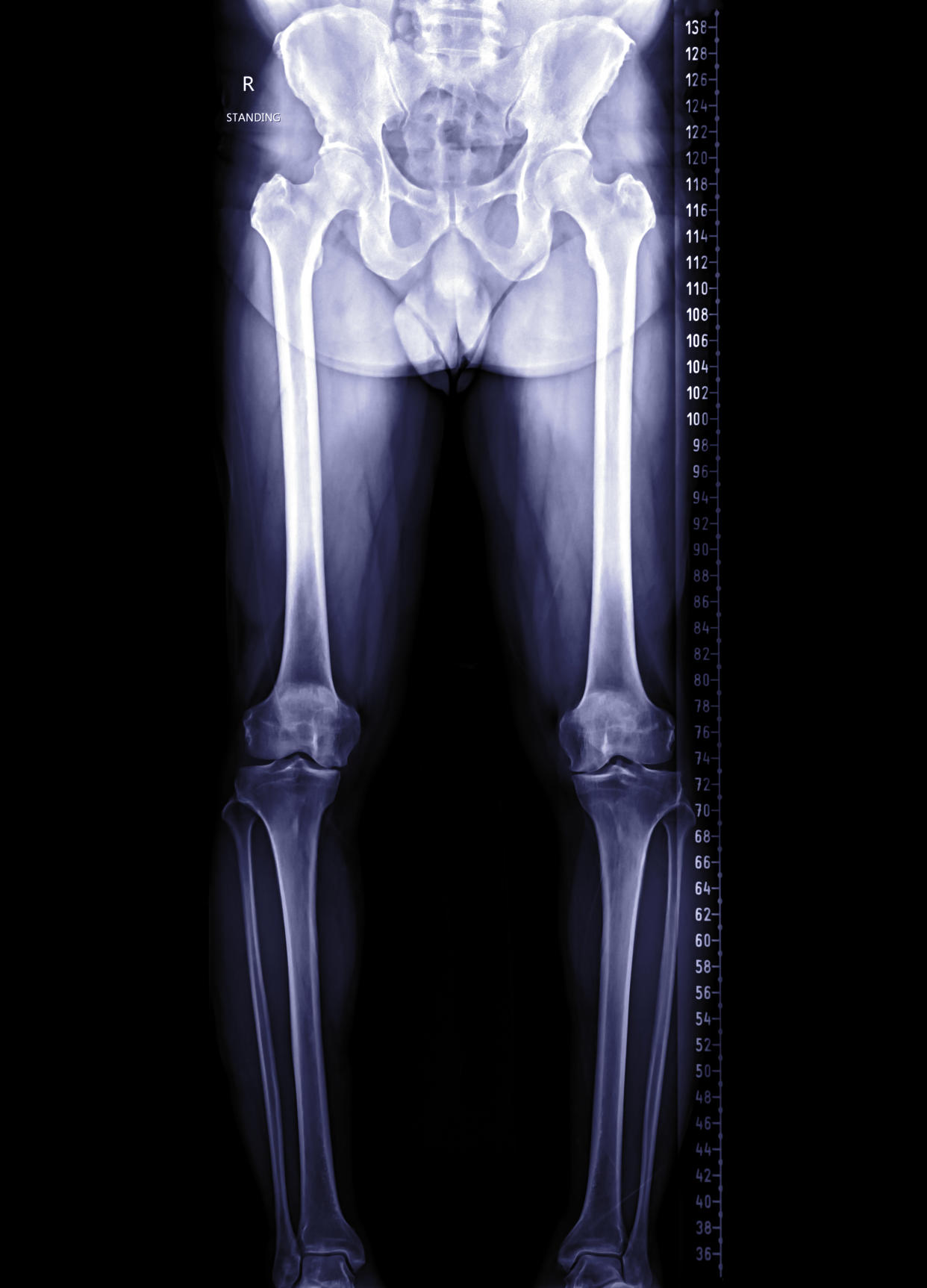 scanogram of lower limb or X-ray image of total lower extremity . Medical background concept.