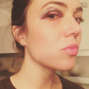 <p>Ouch! “Shower door handle- 1, Mandy- 0,” the <em>This Is Us</em> star captioned this painful looking photo of her injuries from an on-set mishap. “Real talk: how does a girl get rid of a black eye pronto? Any helpful hints (minus Ice and arnica??). Thanks @stokerplasticsurgery for coming in at 9pm to sew me up!! Never had stitches or a black eye before… what a day!” (Photo: <a rel="nofollow noopener" href="https://www.instagram.com/p/BYfRzr4Hzhc/?taken-by=mandymooremm" target="_blank" data-ylk="slk:Mandy Moore via Instagram;elm:context_link;itc:0;sec:content-canvas" class="link ">Mandy Moore via Instagram</a>) </p>