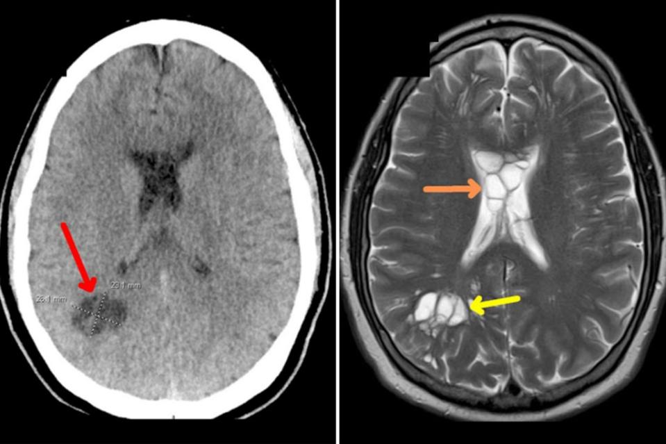 A man contracted a bizarre tapeworm in his brain after eating undercooked bacon.