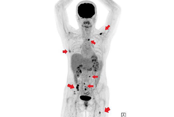 箭頭所指為正子電腦斷層造影，顯示蝕骨性的癌細胞轉移之處。（圖片／澄清醫院提供）