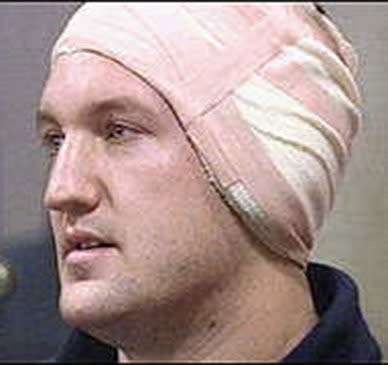 London Scottish flanker Simon Fenn emerged from a ruck in a 1998 club game with Bath missing both the ball and part of his ear. His injury required 25 stitches. He had little idea who the perpetrator was, but suspicion fell on prop Kevin Yates and despite his denials Yates was suspended for six months.