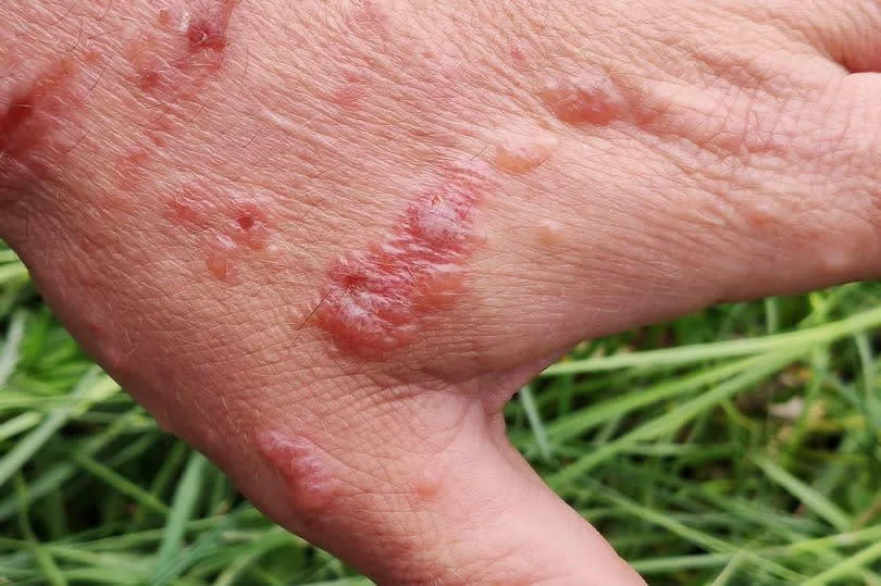 First degree burn of skin from Giant Hogweed