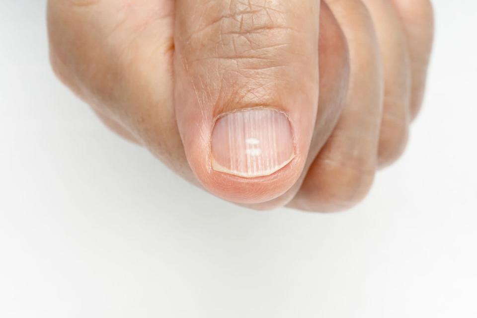 Einige Menschen haben weiße Flecken auf ihren Fingernägeln. Eine häufige Erklärung: Falsche Ernährung und dadurch Kalziummangel. Stimmt das? Stimmt nicht! Die weißen Stellen sind lediglich kleine Lufteinschlüsse - und medizinisch nicht bedenklich. Sie wachsen einfach mit der Zeit wieder heraus. (Bild: iStock / Toa55)