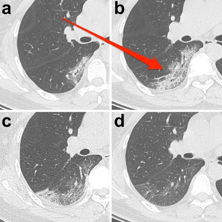 crazy paving pattern CT lung