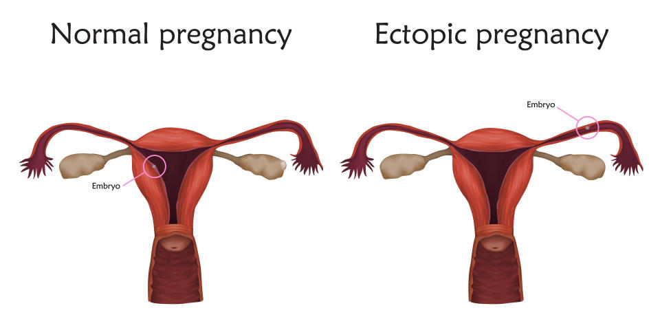 Ectopic and normal pregnancy, illustration. In an ectopic pregnancy the embryo implants in the fallopian tube, not in the uterus. / Credit: VERONIKA ZAKHAROVA/SCIENCE PHOTO