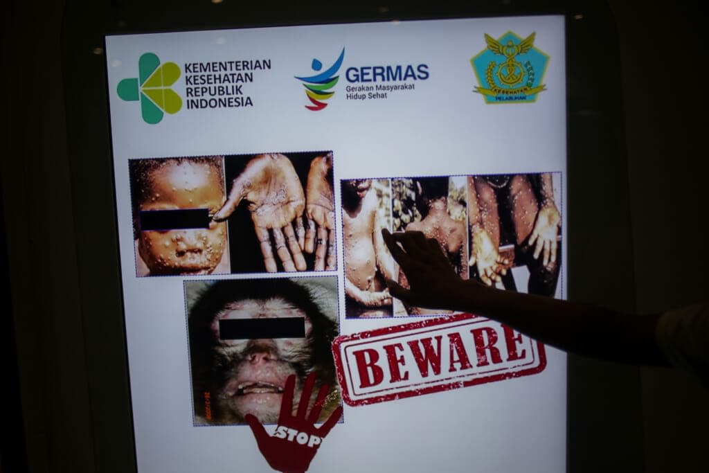 A passenger walk in front of a monkeypox virus information at Soekarno-Hatta International Airport in Tangerang near Jakarta, Indonesia on May 15, 2019. (Photo credit should read Jepayona Delita/Future Publishing via Getty Images)