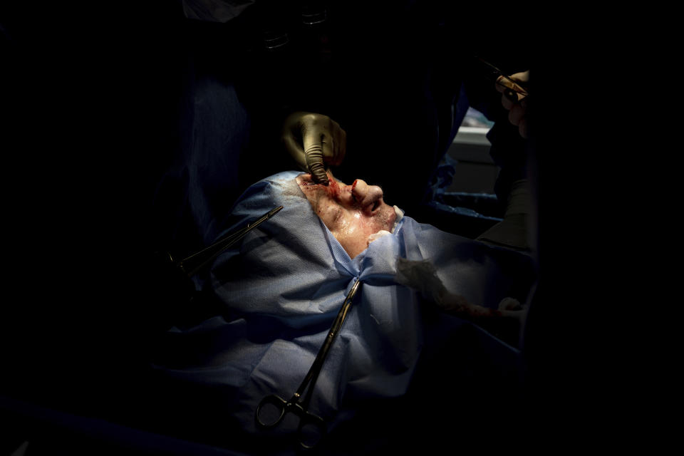 Dr. Natalia Komashko, performs reconstructive surgery on the nose of Leonid Prokopovych, a 50-year-old Ukrainian serviceman, in Ivano-Frankivsk, Ukraine, Friday, July 21, 2023. It was his third nasal surgery, and he had a series of operations to repair his hands as well. Ukraine is facing the prospect of a future with upwards of 20,000 amputees, many of them soldiers who are also suffering psychological trauma from their time at the front. (AP Photo/Evgeniy Maloletka)