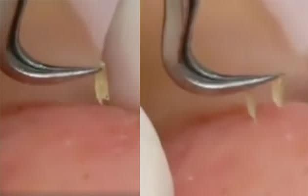 The tweezers are seen to be removing pus from a person's face. Photo: Boxamall