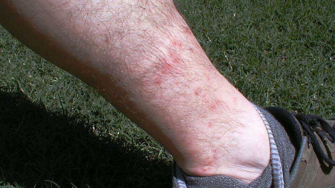 You likely won’t see chiggers when they are biting you, but they leave clusters of itchy red bumps on your skin. You can encounter the teeny red bugs while walking in wooded areas or on trails with tall grass, but also in a park, on a golf course, or just standing in your own yard.