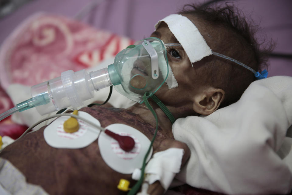 A malnourished girl Rahmah Watheeq receives treatment at a feeding center at Al-Sabeen hospital in Sanaa, Yemen, Tuesday. Nov. 3, 2020. Two-thirds of Yemen's population of about 28 million people are hungry, and nearly 1.5 million families currently rely entirely on food aid to survive, with another million people are set to fall into crisis levels of hunger before the year end, according to aid agencies working in Yemen. (AP Photo/Hani Mohammed)