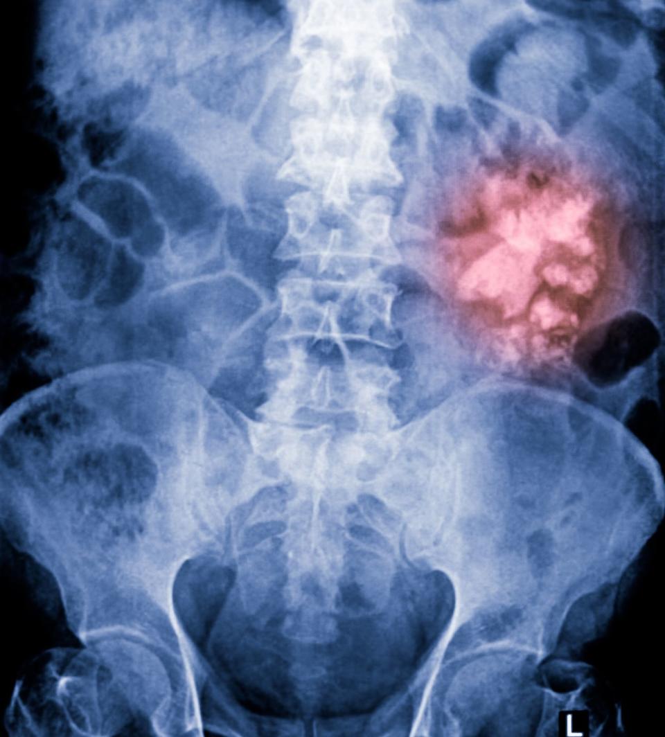 <p>Kidney stones are hard deposits that form when chemicals in your urine crystallize and <a href="https://www.mayoclinic.org/diseases-conditions/kidney-stones/symptoms-causes/syc-20355755" rel="nofollow noopener" target="_blank" data-ylk="slk:start to stick;elm:context_link;itc:0;sec:content-canvas" class="link ">start to stick</a> together. An urge to pee more often and a pungent urine odor can be signs of a kidney stone trying to work its way through your body (and possibly giving you a bladder infection in the process). </p><p>If your pee smells off and you have severe pain on either side of your lower back, seek medical advice as soon as possible and <a href="https://www.kidney.org/atoz/content/kidneystones" rel="nofollow noopener" target="_blank" data-ylk="slk:get that stone out;elm:context_link;itc:0;sec:content-canvas" class="link ">get that stone out</a>. <br><strong><br>Related:</strong> <a href="https://www.menshealth.com/health/a19547105/symptoms-of-kidney-stones/" rel="nofollow noopener" target="_blank" data-ylk="slk:6 Symptoms of Kidney Stones You Shouldn’t Ignore;elm:context_link;itc:0;sec:content-canvas" class="link ">6 Symptoms of Kidney Stones You Shouldn’t Ignore</a></p>