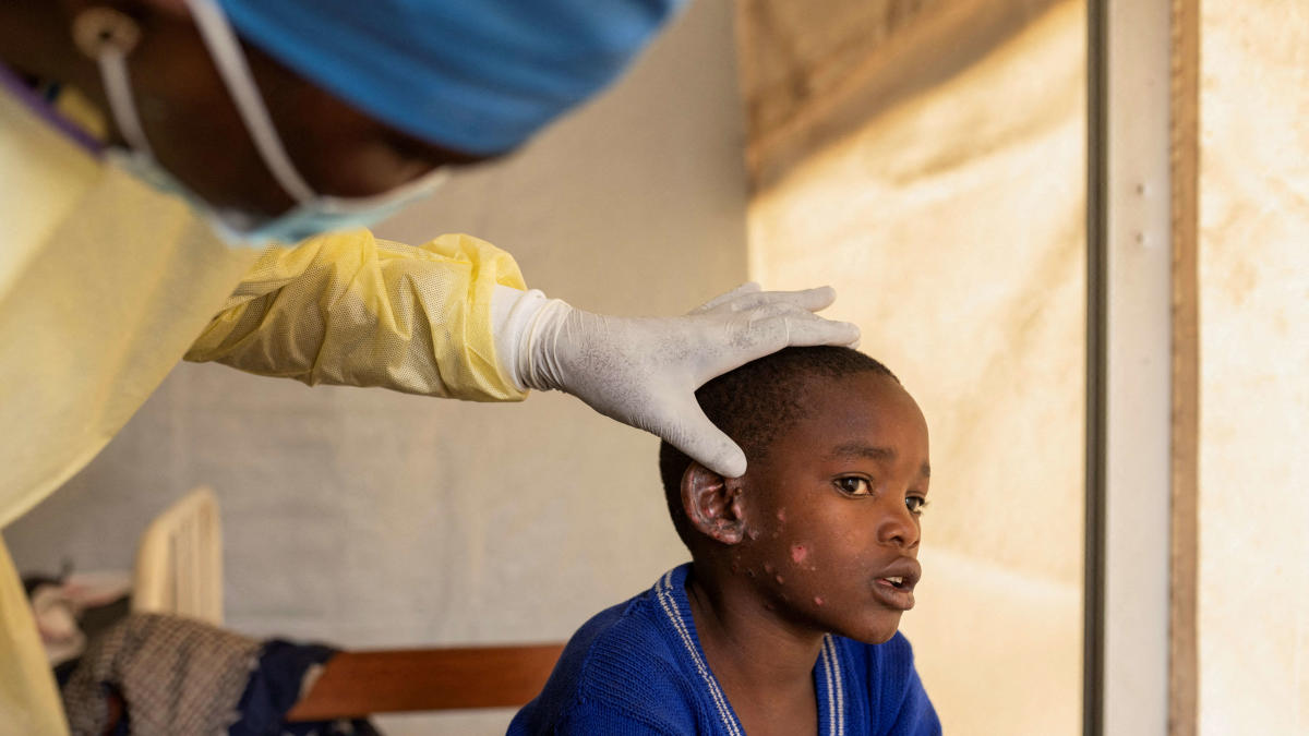 Épidémie de « mpox » 2024 en Afrique : pourquoi les scientifiques la jugent plus préoccupante que celle de 2022