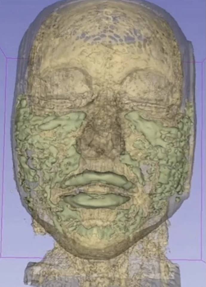 Scan médical 3D d'un visage humain, montrant des structures squelettiques et faciales détaillées, avec des densités variables mises en évidence. Aucun texte ni objet supplémentaire n'est présent