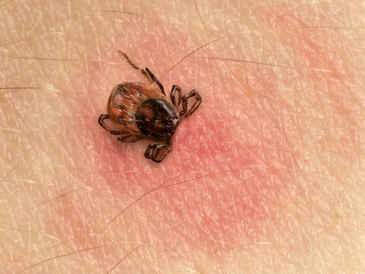 An engorged tick biting into human flesh. <i>(Image via Getty).</i>