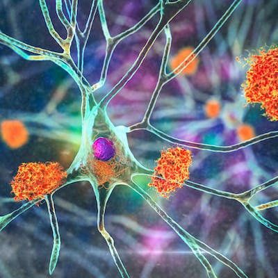 El estudio de los beta-amiloides como proteínas anormales que causan la enfermedad de Alzheimer no se ha traducido en un fármaco o terapia útil. Shutterstock