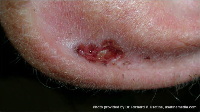 skin cancer pictures: photo of a basal cell carcinoma