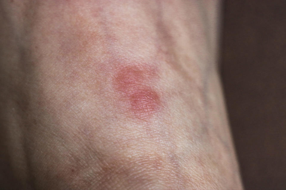 Red inflammation from an ant bite to the skin of the foot. (Svetlana Sarapultseva / Getty Images)