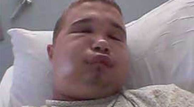 After: The bite landed the teen in a Tampa hospital with a severely swollen face. Photo: Facebook