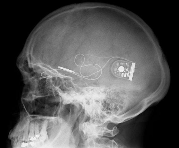 A wire trails from inside the eye to its edge and then under the skin to a point behind the ear (shown here in this X-ray image), where patients can place a control box to wirelessly supply power. Patients can also use the control box to adjust