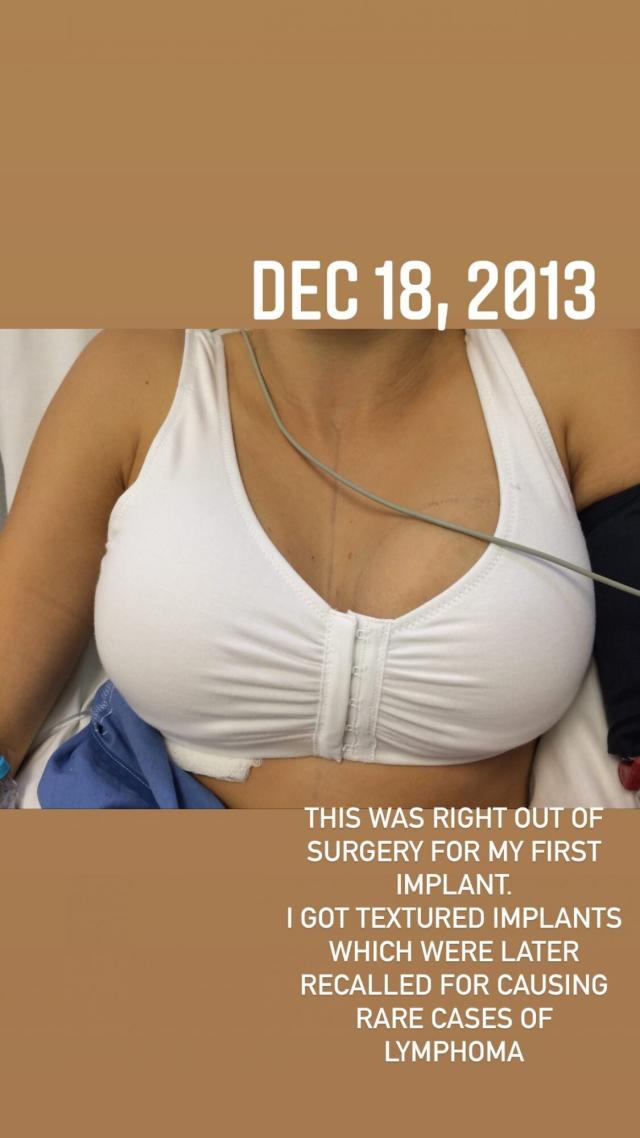 Kayla Lochte Shares Photos of Her Breast Implants Through the Years