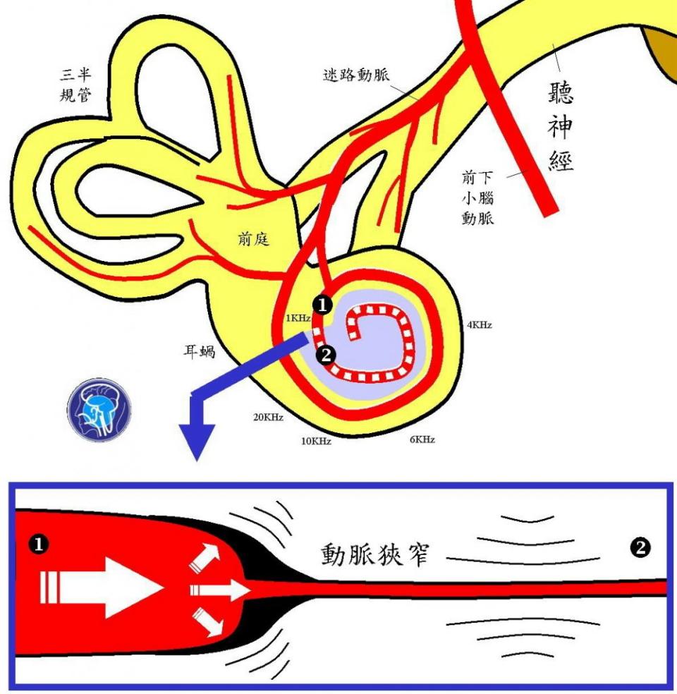 遠端段耳蝸管動脈發生狹窄（下方藍箭頭處）出現搏動性耳鳴，更遠端之耳蝸管動脈缺血（圖上2號虛線處），1000 Hz以下之耳蝸管功能不良（紫色區域）。（醫師陳建志提供）