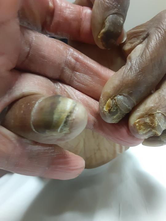 This February 2021 photo provided by Tamika Dalton shows the fingernails of her mother, Theresa Dalton, at the the Blumenthal Nursing and Rehabilitation Center in Greensboro, N.C. When COVID-19 kept visitors from going inside, Dalton would often visit at her mother’s window a couple times a day. Through the glass, Dalton didn’t like what she saw: Fewer and fewer aides passed by, and her mother sometimes sat for hours in a soiled diaper. (Tamika Dalton via AP)