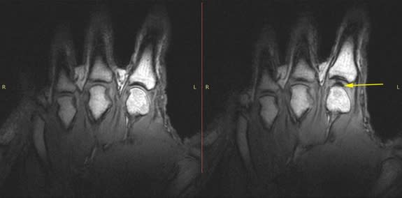 An MRI image of the same hand before knuckle cracking (left) and after (right), showing the void (dark spot) in the joint fluid that forms when the knuckles are cracked.