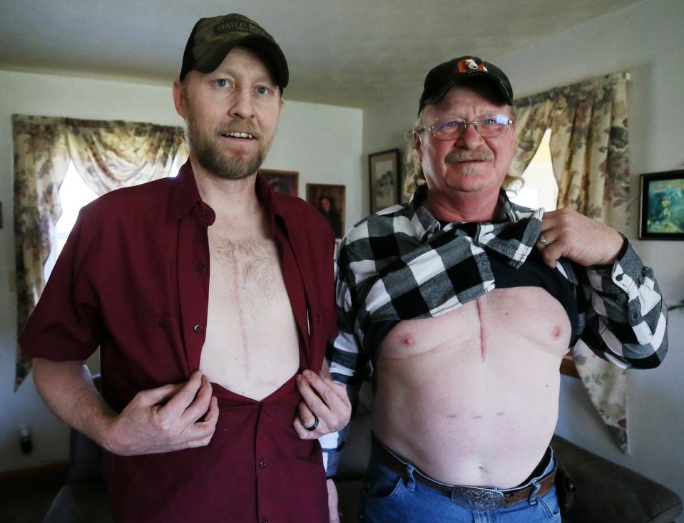 Kip Stackpole, left, and his older brother Ricky show off their scars from open heart surgery. The brothers talked Monday, March 11, 2024, at Ricky's home in Rootstown about suffering heart attacks and being in the hospital at the same time in July 2023.