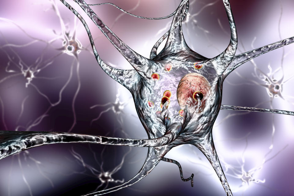 Parkinsons disease nerve cells. Computer illustration of human nerve cells affected by Lewy bodies (small red spheres inside cytoplasm of neurons) in the brain of a patient with Parkinsons disease. Lewy bodies are abnormal accumulations of protein that develop inside nerve cells in Parkinsons disease, Lewy Body Dementia, and some other neurological disorders.