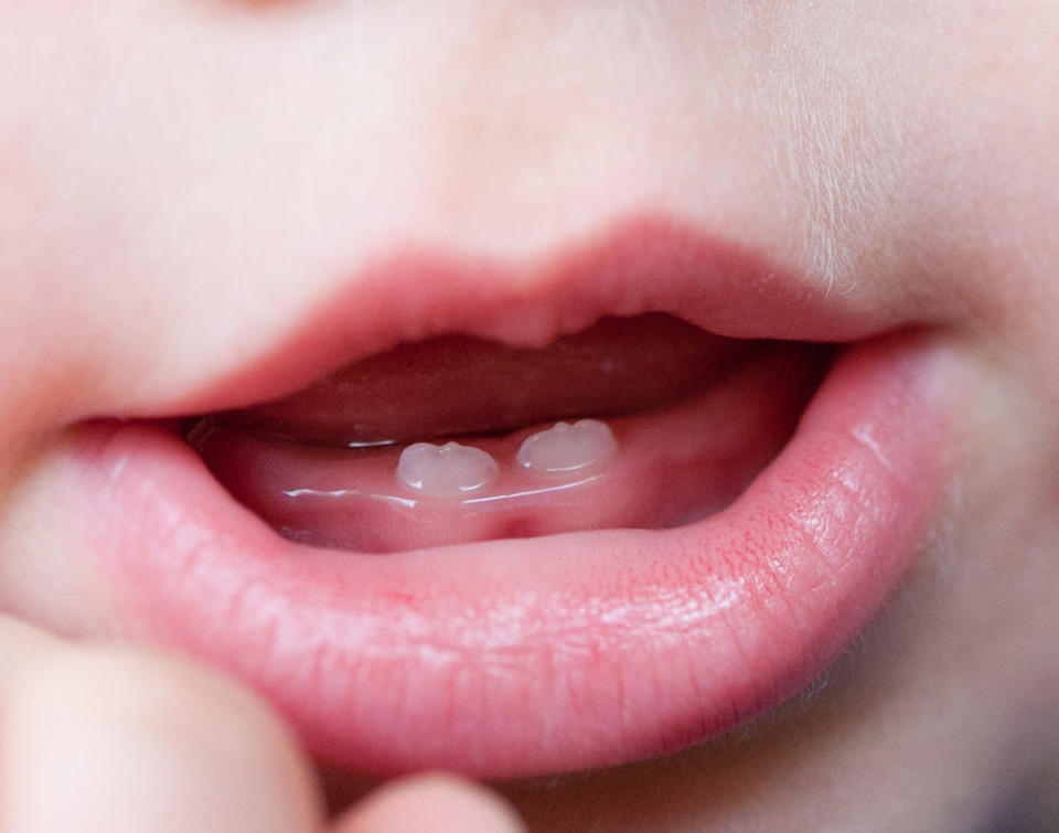 Image of baby teeth on child after Brauer Teething Gel was recalled due to bacterial contamination.