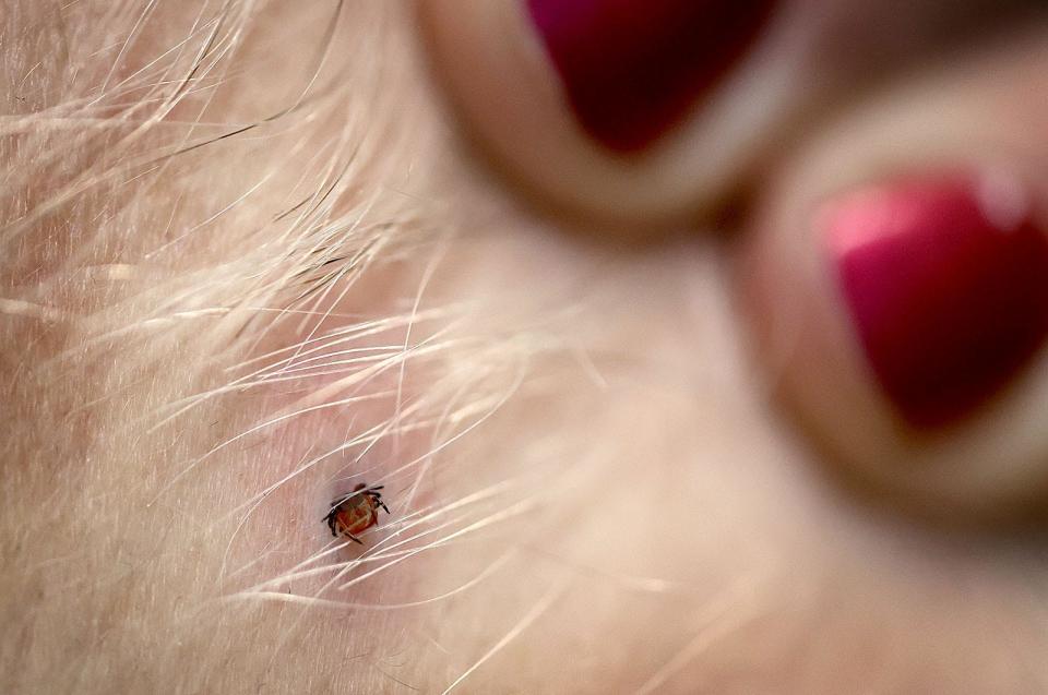 Tick season is here. With the mild winter and no deep freeze, ticks are out early. This deer tick was embedded in a woman's neck. Left unchecked, deer ticks can transmit Lyme disease to humans.