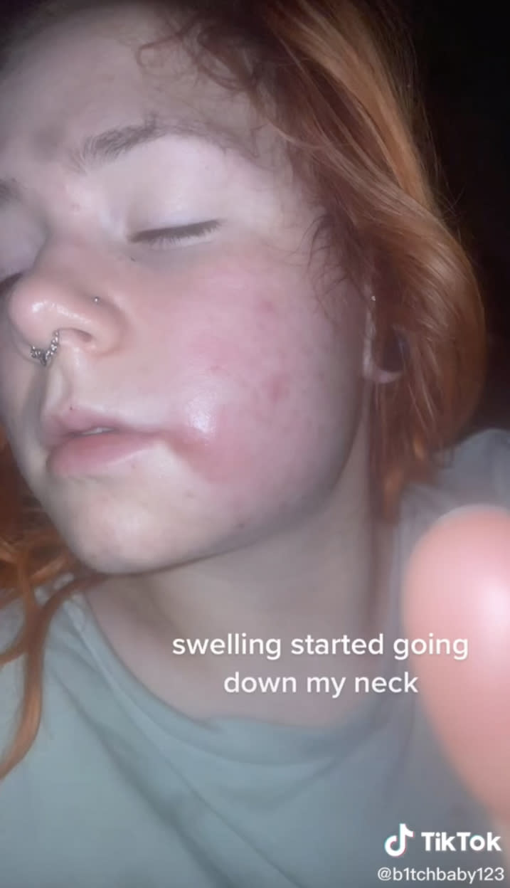 Never Again Scary Outcome After Womans Innocuous Pimple Pop