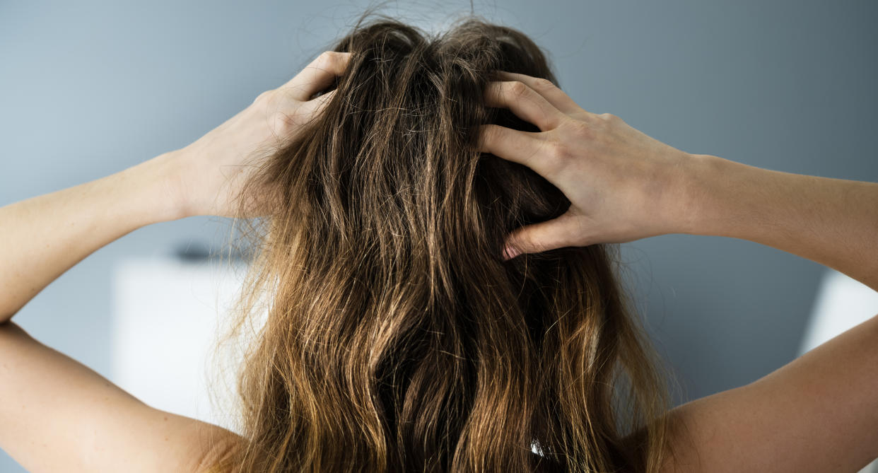 Itchiness and dandruff can be signs of poor scalp health. (Getty Images)