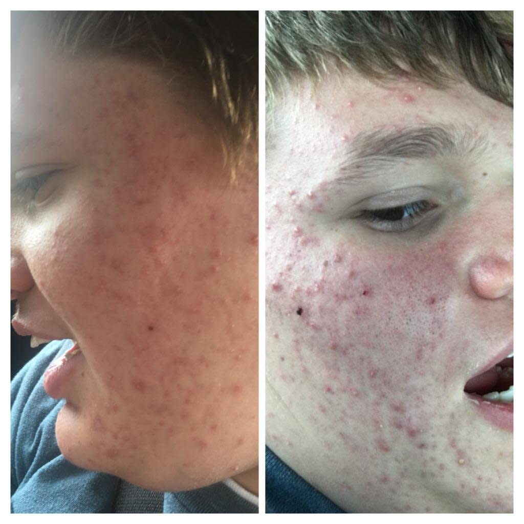 Redditors in the Skincare Addiction community banded together to offer acne-clearing advice for Alec Ross-Smith, a teen with autism. (Photos: Callie Ross-Smith)