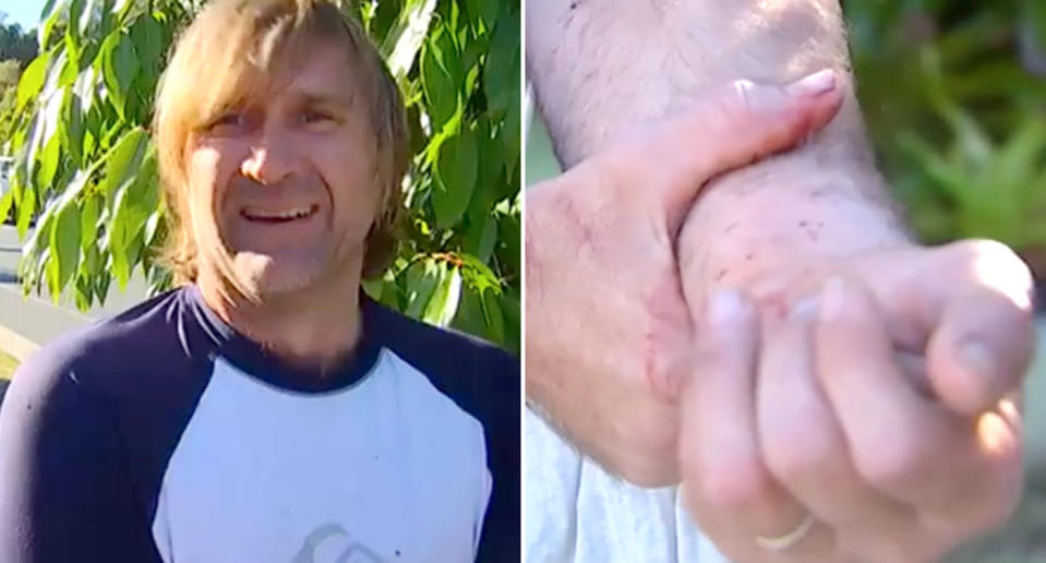 Craig McDougall, a paddle boarder, speaks with the media while holding his wrist. He believes he was bitten by a shark in Pelican Waters on Tuesday.