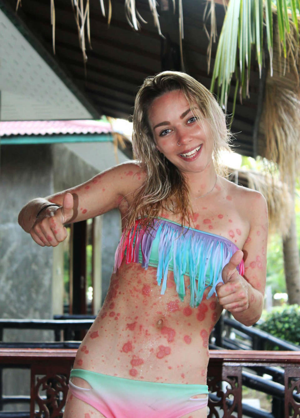 Giorgia Lanuzza tenía 13 añitos cuando la diagnosticaron psoriasis, otra extraña enfermedad que causa descamación e inflamación en la piel. Aunque entonces le costó aceptarlo, actualmente ya no tiene ningún problema en mostrar su cuerpo en las redes sociales. Una actitud que, sin duda, ayudará a otras personas que también la sufren. (Foto: Facebook / Giorgia Lanuzza).