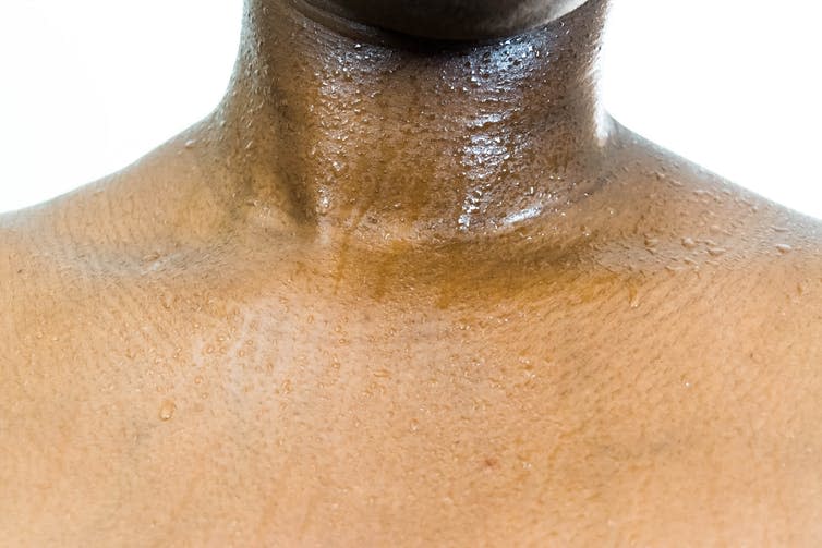 <span class="caption">The sweating can be constant, and occur in unusual places on the body.</span> <span class="attribution"><a class="link " href="https://www.shutterstock.com/image-photo/close-shot-african-black-womans-sweaty-1098119765?src=vj79qcWWls6TxR4fO82wUA-2-45" rel="nofollow noopener" target="_blank" data-ylk="slk:Red Confidential/Shutterstock.com;elm:context_link;itc:0;sec:content-canvas">Red Confidential/Shutterstock.com</a></span>