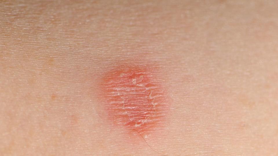 tinea corporis infection ring worm