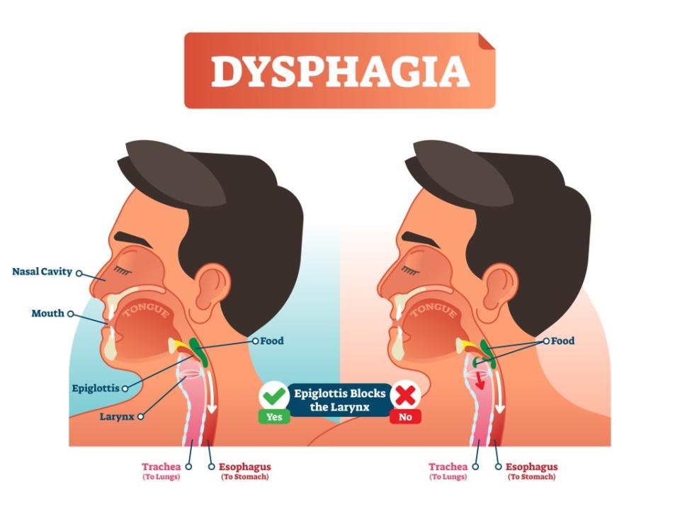 An illustration of dysphagia is shown, one of the symptoms that can show in people with early stages of dementia. VectorMine – stock.adobe.com