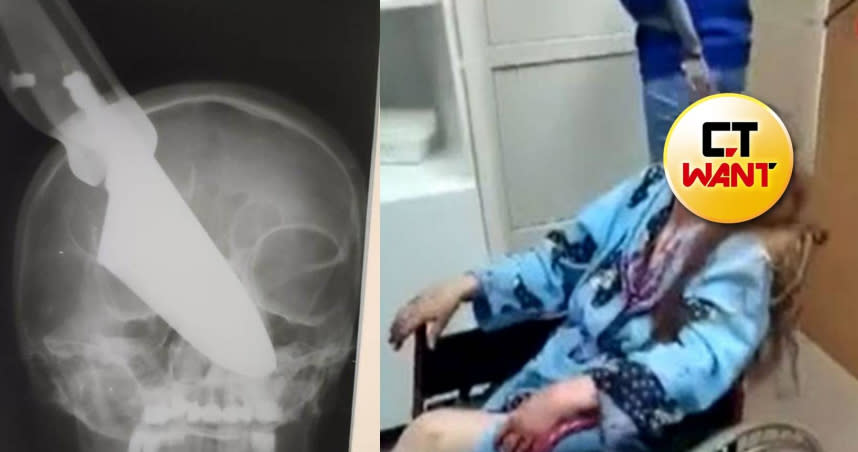 俄羅斯一名婦人遭丈夫持25公分的長刀刺進臉部。（組合圖∕翻攝自推特）