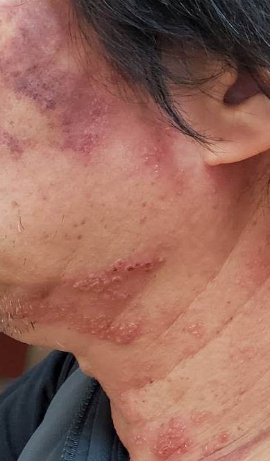 帶狀皰疹也會長在臉上。（圖／診所提供）